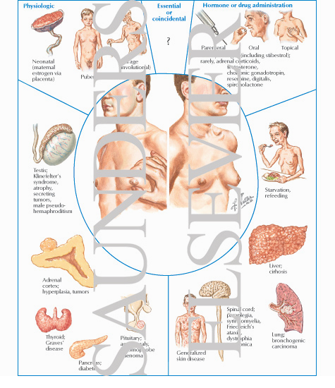 Gynecomastia