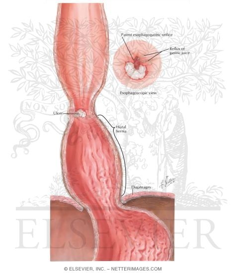 Esophagitis, Esophageal Ulcers - Marginal Ulceration with Hiatal Hernia