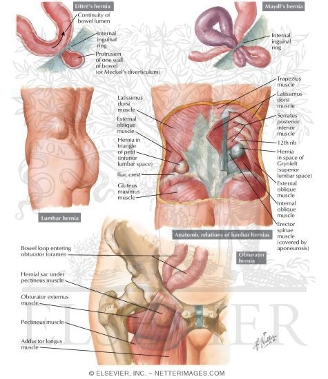 Hernia V - Lumbar and Obturator Hernias
