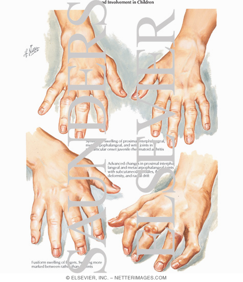 Polyarticular Juvenile Rheumatoid Arthritis 