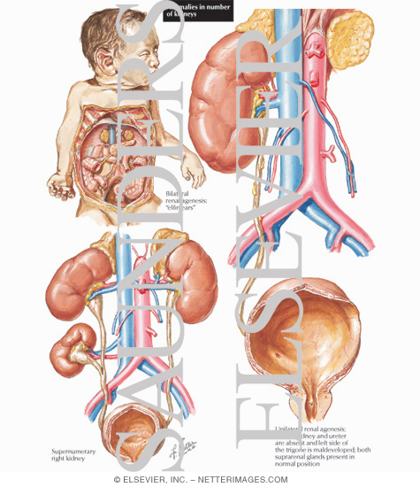 Anomalies in Number of Kidneys