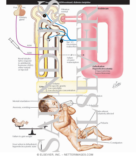 Nephrogenic Diabetes Insipidus