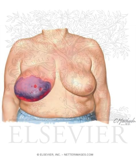 Vitamin K Antagonist-Induced Skin Necrosis