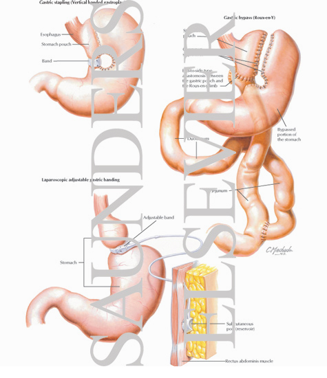 Bariatric Surgery