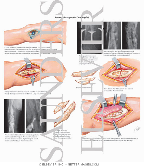 Recurrent Postoperative Osteomyelitis