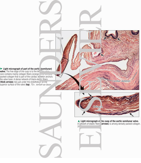 Light Micrograph of Part of the Aortic (semilunar) Valve With Light Micrograph of the Cusp of the Aortic Semilunar Valve