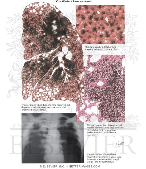 Coal Worker's Pneumoconiosis