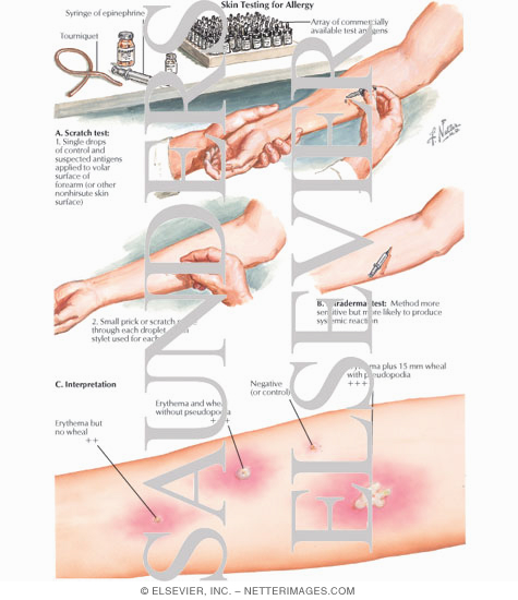 Skin Testing for Allergy