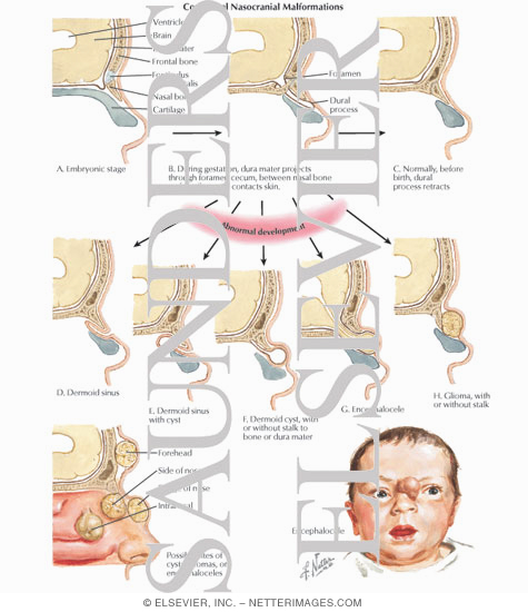 Congenital Nasocranial Malformations