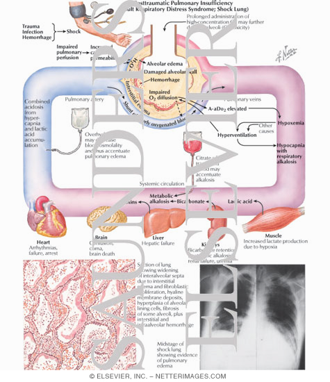 Posttraumatic Pulmonary Insufficiency (Adult Respiratory Distress Syndrome; Shock Lung)