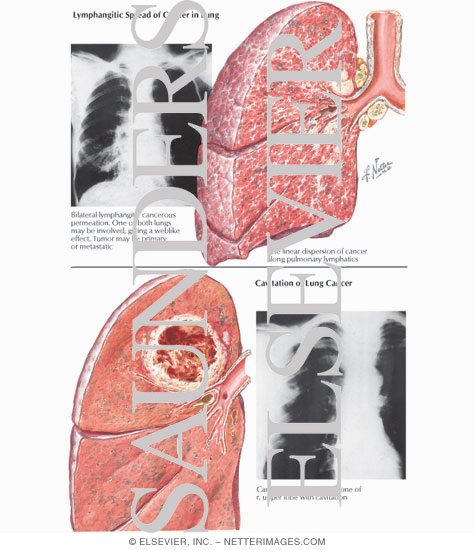 Lymphangitic Spread of Cancer in Lung