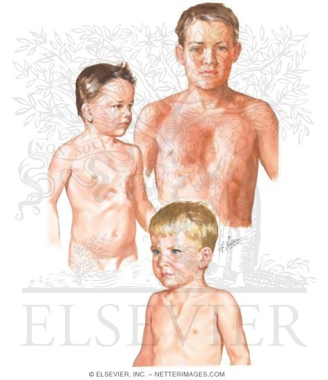 Congenital Deformities of Thoracic Cage
