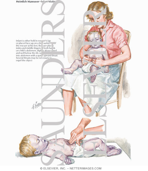 Hemlich Maneuver - Infant Victim