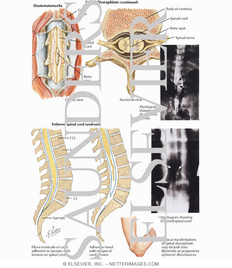 Spinal Dysraphism