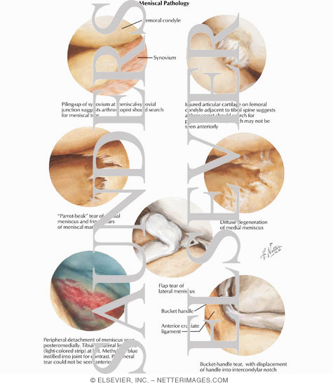 Tears of Meniscus