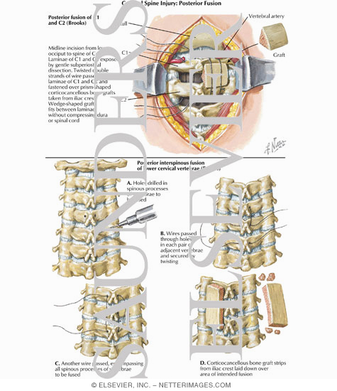 Cervical Spine Injury: Posterior Fusion
