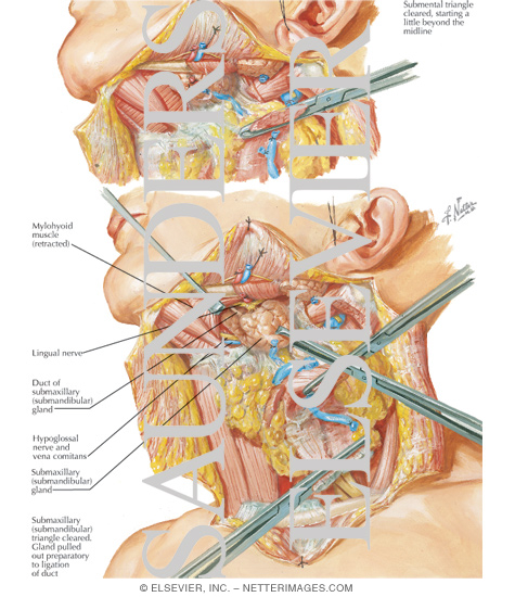 Radical Neck Dissection