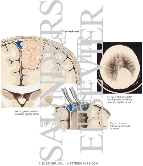 Meningiomas