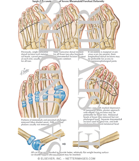 Surgical Reconstruction of Severe Rheumatoid Forefoot Deformity