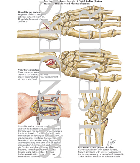 Styloid Process Wrist