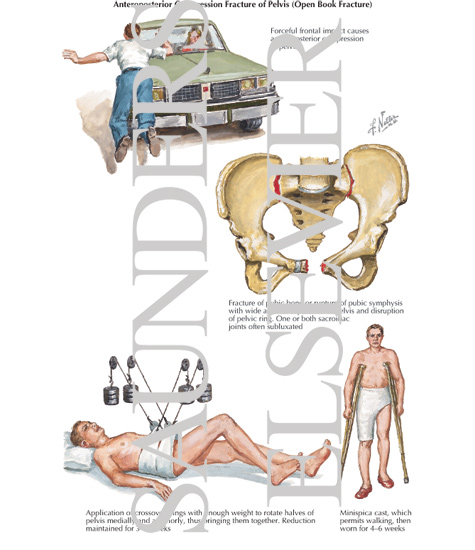 Anteroposterior Compression Fracture of Pelvis (Open Book Fracture)