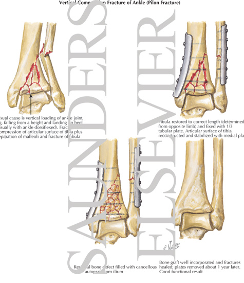 Vertical Compression Fracture of Ankle (Pilon Fracture)
