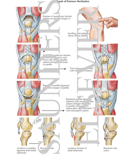 Disruption of Quadriceps Femoris Tendon or Patellar Ligament