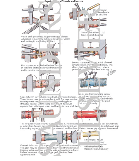 Repair of Blood Vessels and Nerves