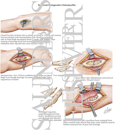 Recurrent Postoperative Osteomyelitis