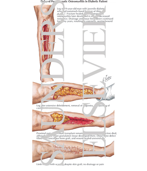 Delayed Posttraumatic Osteomyelitis in Diabetic Patient