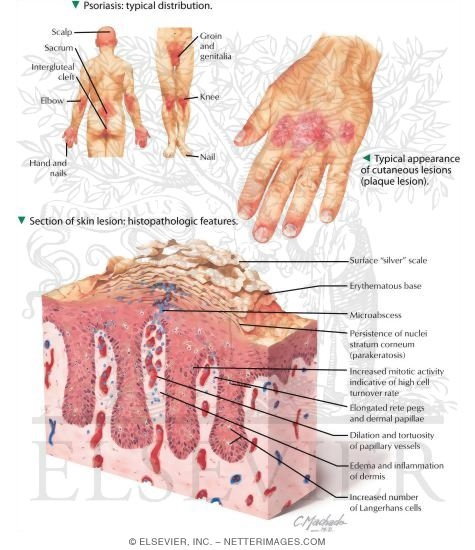 Psoriasis Histology