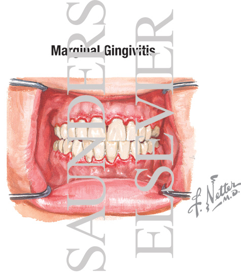 Marginal Gingivitis