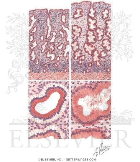 Schematic of the Endometrium During Early Secretory (left) and Midsecretory (right) Phases of the Menstrual Cycle