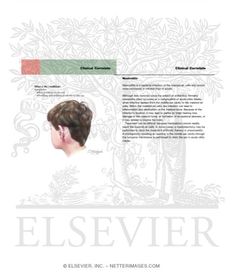 Mastoiditis