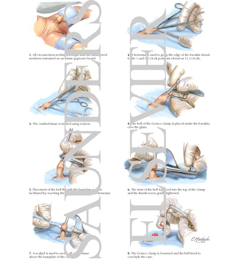 Circumcision (male; Newborn and Infant)