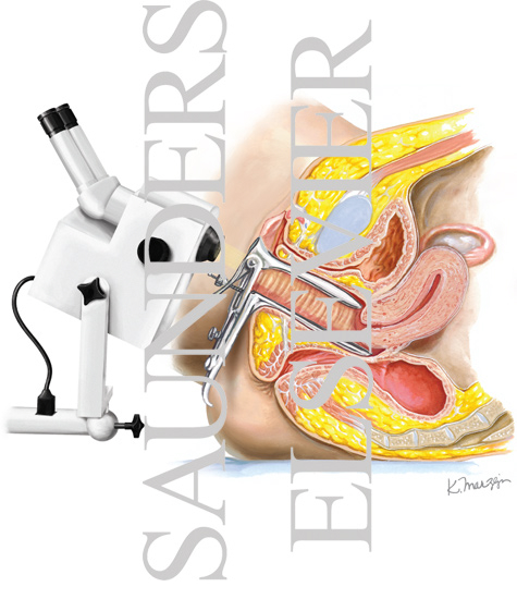 Colposcopy
