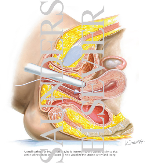 Sonohysterography