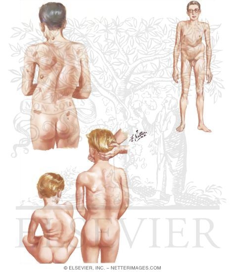 marfany#39;s syndromes marfany#39;s syndromes