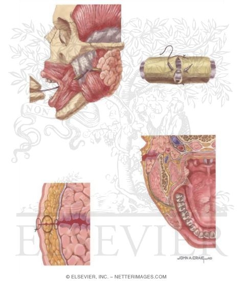 parotid duct injury