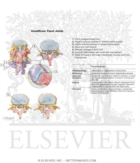 Conditions of the Facet Joints