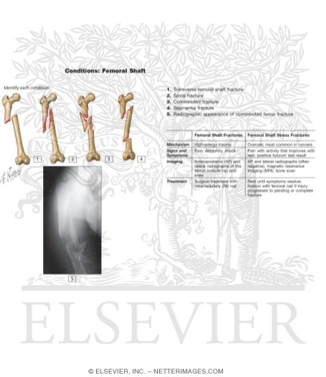 Conditions of the Femoral Shaft