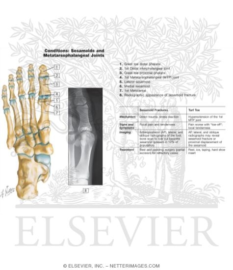 Conditions of the Sesamoids and Metatarsophalangeal Joints
