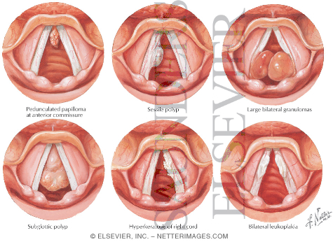 Miscellaneous Disorders of the Larynx
Lesions of the Vocal Cords
