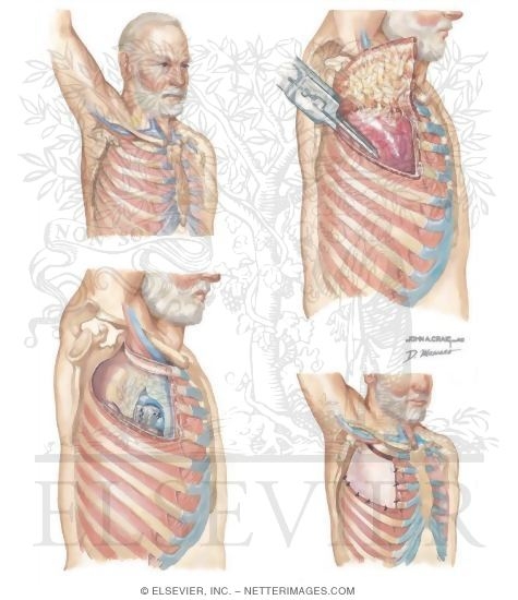 Chest Wall Resection and Reconstruction In Superior Sulcus Tumor