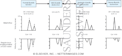 Echocardiographic Evaluation Of Diastolic Function Can Be Used To