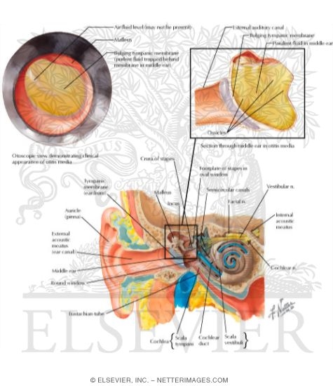 Acute Otitis Media