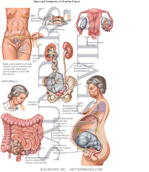 Stomach Cancer Symptoms Stomach Cancer Symptoms