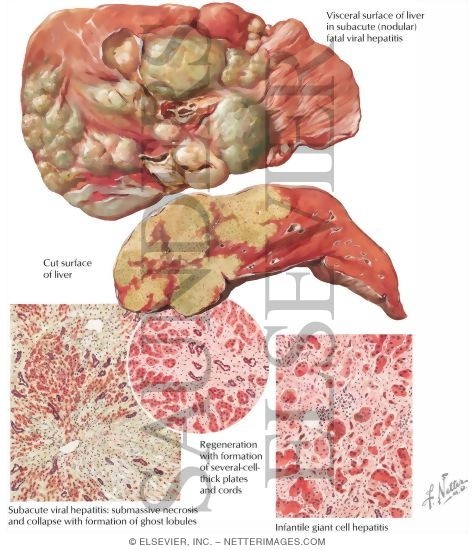 Viral Hepatitis III - Subacute Fatal Form