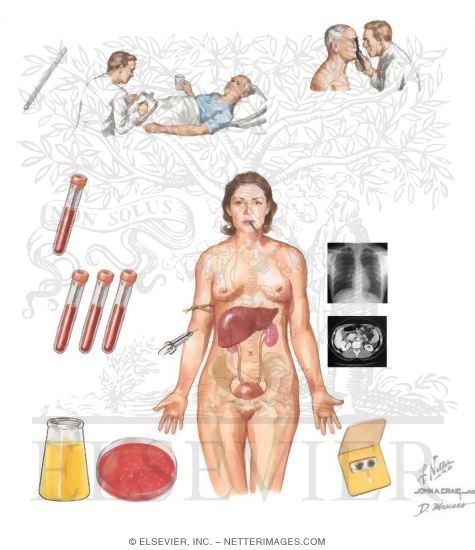 Diagnostic Consideratiosn In Fever of Unknown Origin