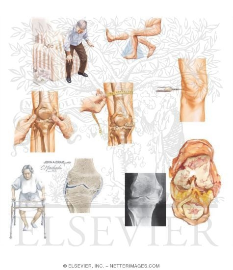 Clinical Findings In Osteoarthritis